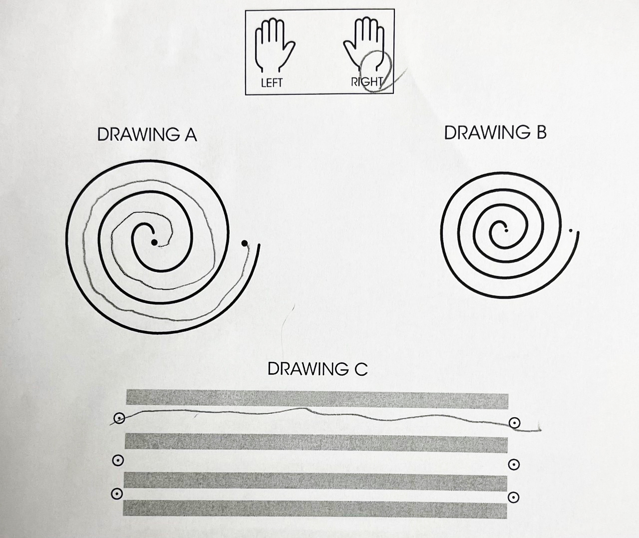 A printed spiral copied by hand to test the effect of a patients treatment for essential tremor following focused ultrasound treatment